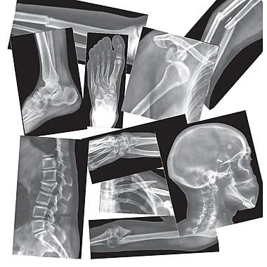 Broken Bones X Ray - louisekool